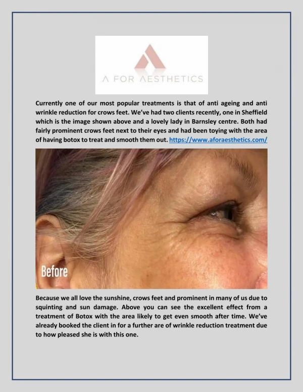 Anti-wrinkle Treatment – A great way to get rid of crows feet