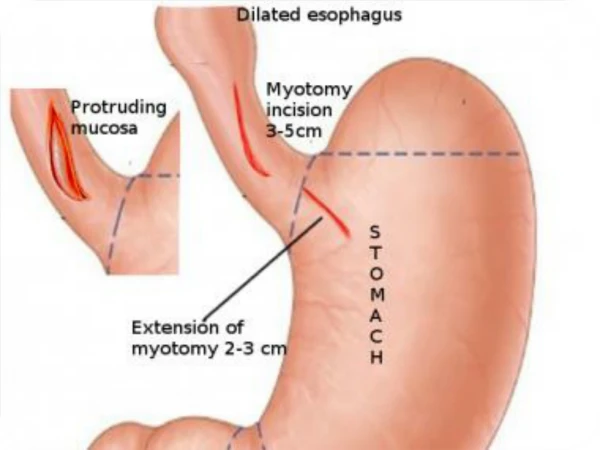 Esophageal Dilatation San Antonio | Gastroenterologist TX | Stone Oak Gastroenterology