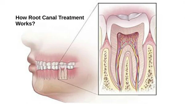 How Root Canal Treatment Works?