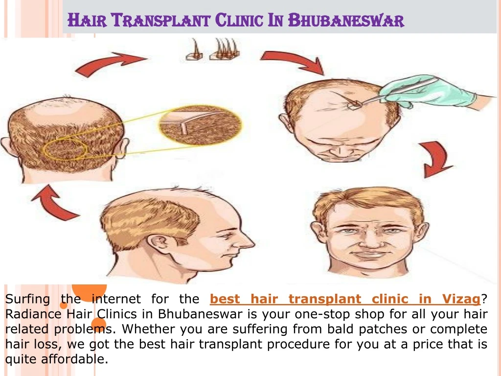 hair transplant clinic in bhubaneswar