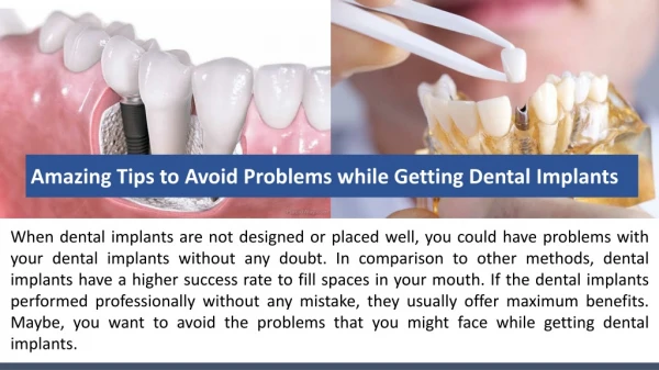 Amazing Tips to Avoid Problems while Getting Dental Implants