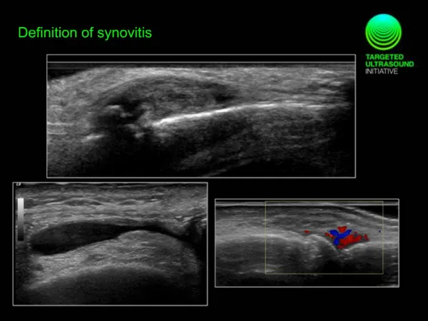 Definition of synovitis