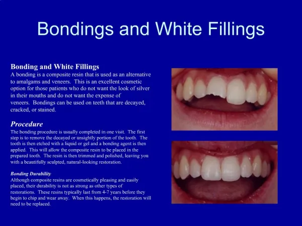 Bondings and White Fillings